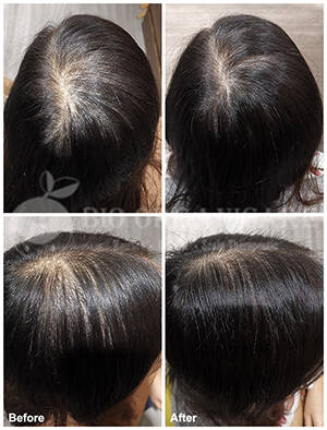 bio organicare, scalp treatment, hair treatment, hair growth, hair regrowth, hair care, scalp solution, hair solution, scalp problem, hair problem, hair centre in singapore, singapore best hair growth, singapore hair loss treatment, best hair loss treatment singapore, natural ingredient, organic ingredient, hair repair, scalp repair, hair salon, organic hair care, natural hair care, hair bath, hair mask, healthy hair, hair loss, hair thinning, greying hair, oily scalp, greasy scalp, itchy scalp, dandruff, flakes, sensitive scalp, alopecia areta, chemical residue, bacteria infected scalp, oil clog scalp, scalp inflammation, dead toxic cell layers, stress hair loss, menopause hair loss, hormonal hair loss, premature hair loss, traction alopecia, chemical hair loss, androgenetic alopecia, ageing scalp hair loss, post natal hair loss, male pattern hair loss, female pattern hair loss, truth hair loss, daily vanity