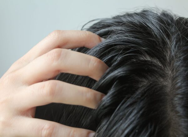 Flakes on My Scalp Flakes on My Scalp