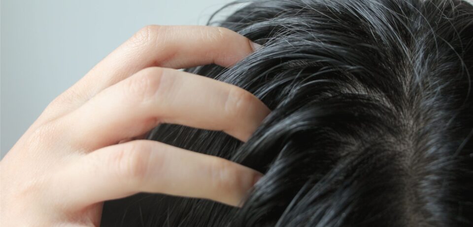 Flakes on My Scalp