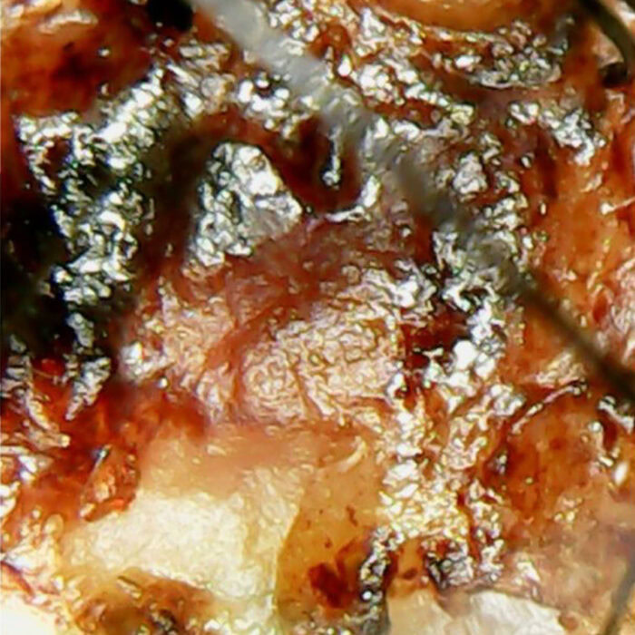 Fungal Infection Before