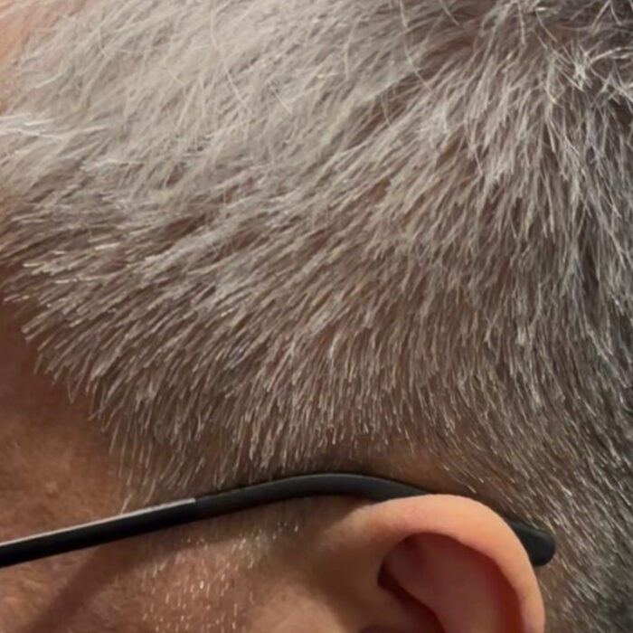 Scalp Disorder After
