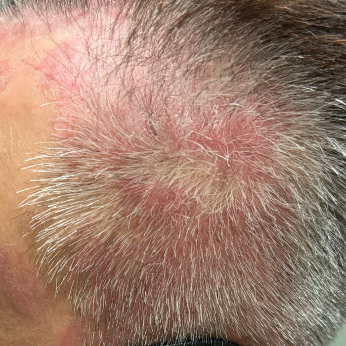 Scalp Disorder Before
