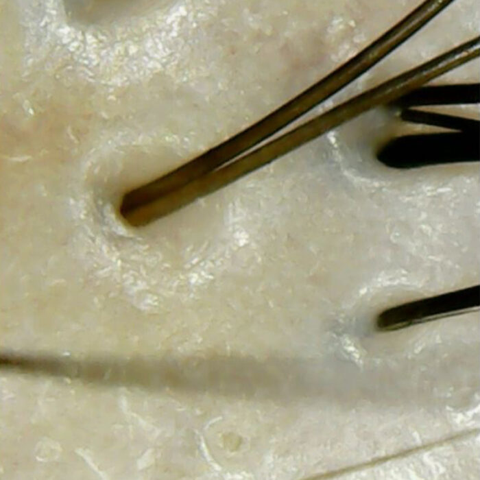 Scalp Inflammation After