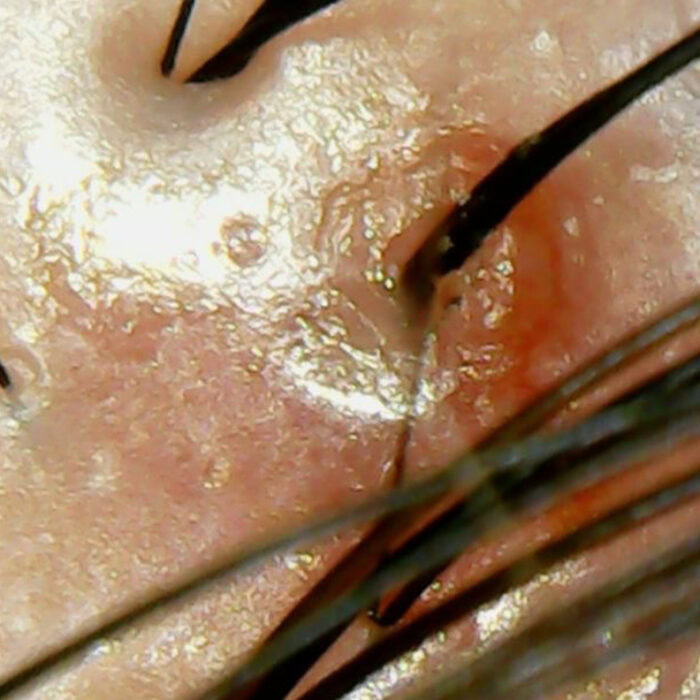 Scalp Inflammation Before