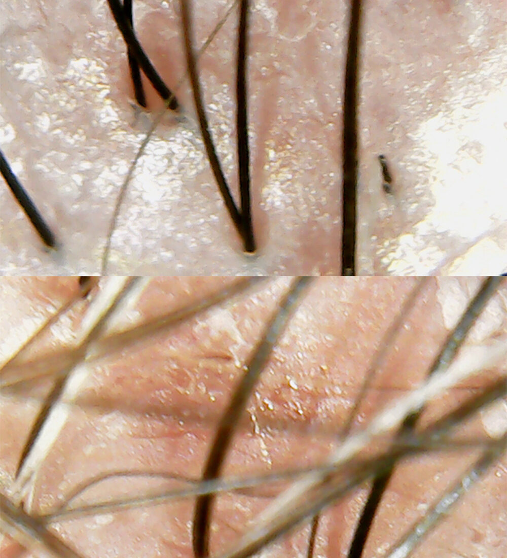 Sensitive Scalp 02
