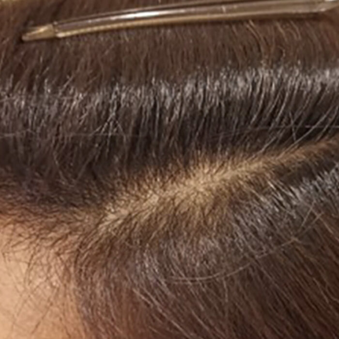 Traction Alopecia After