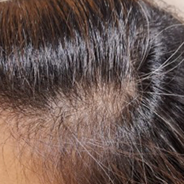 Traction Alopecia Before