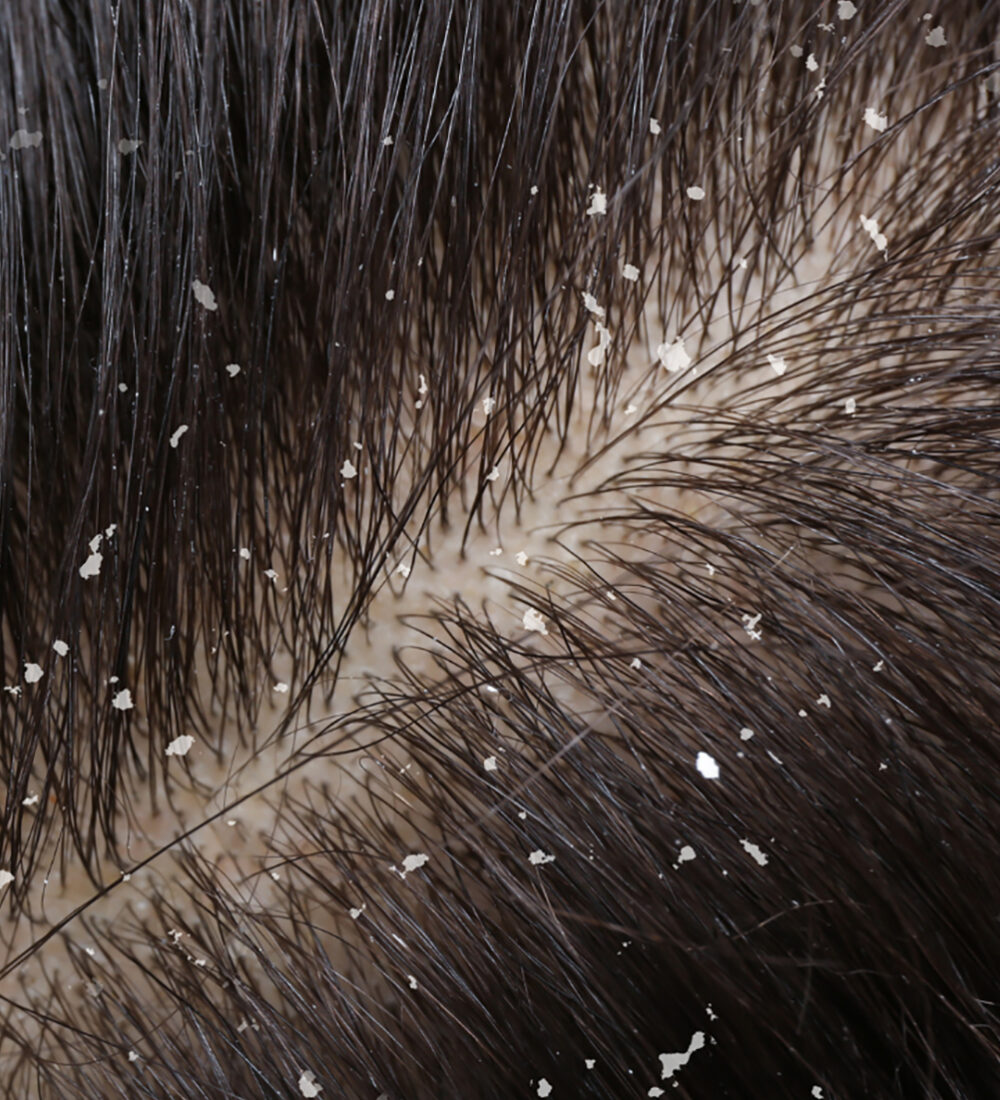 dandruff-FAQ. 2