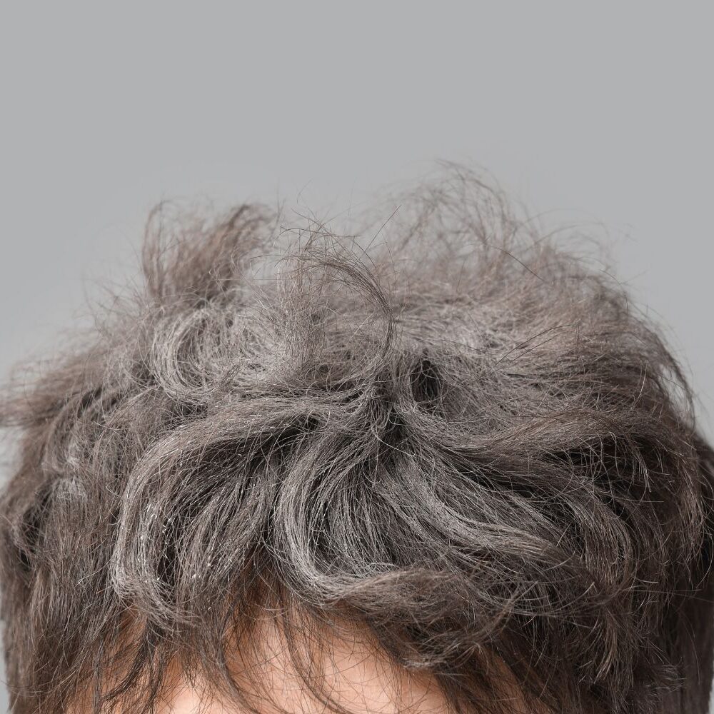 Dry scalp