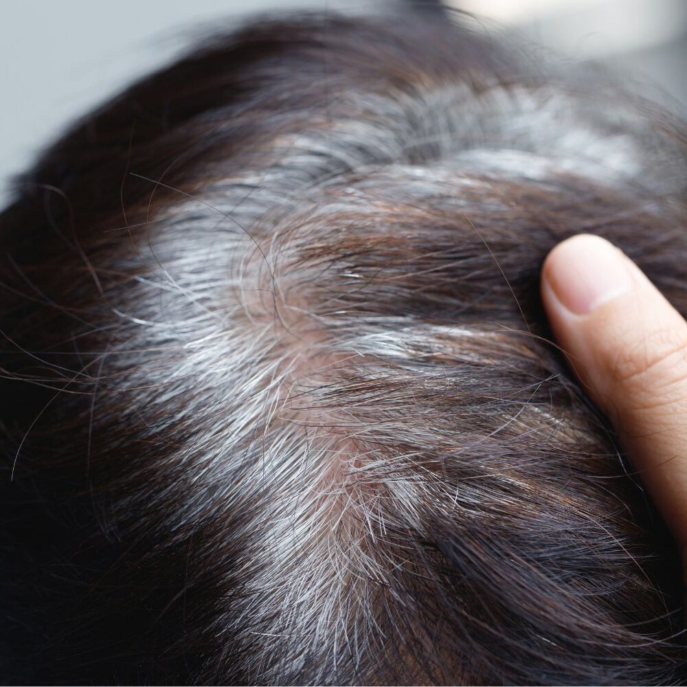 Premature greying