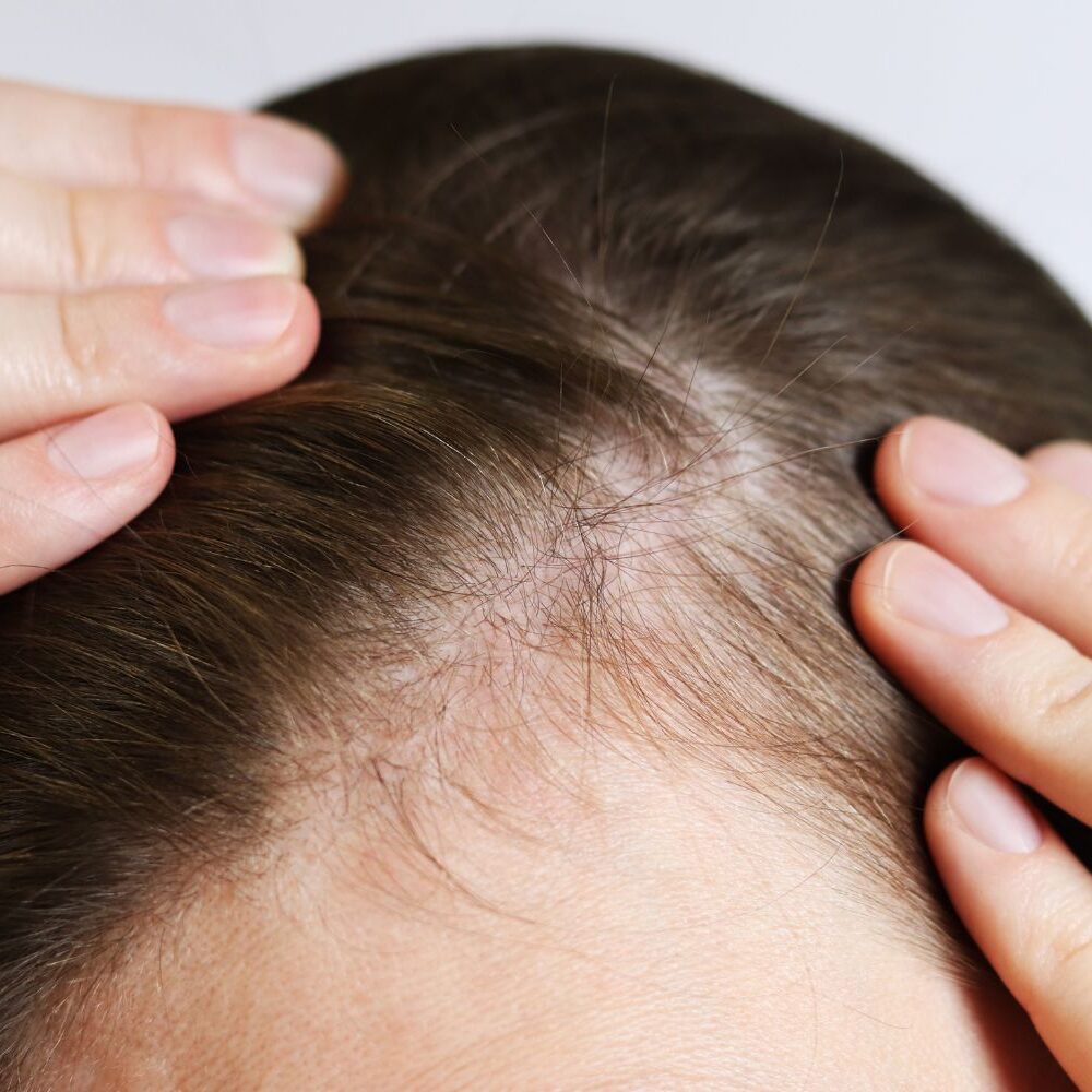 Scalp changes
