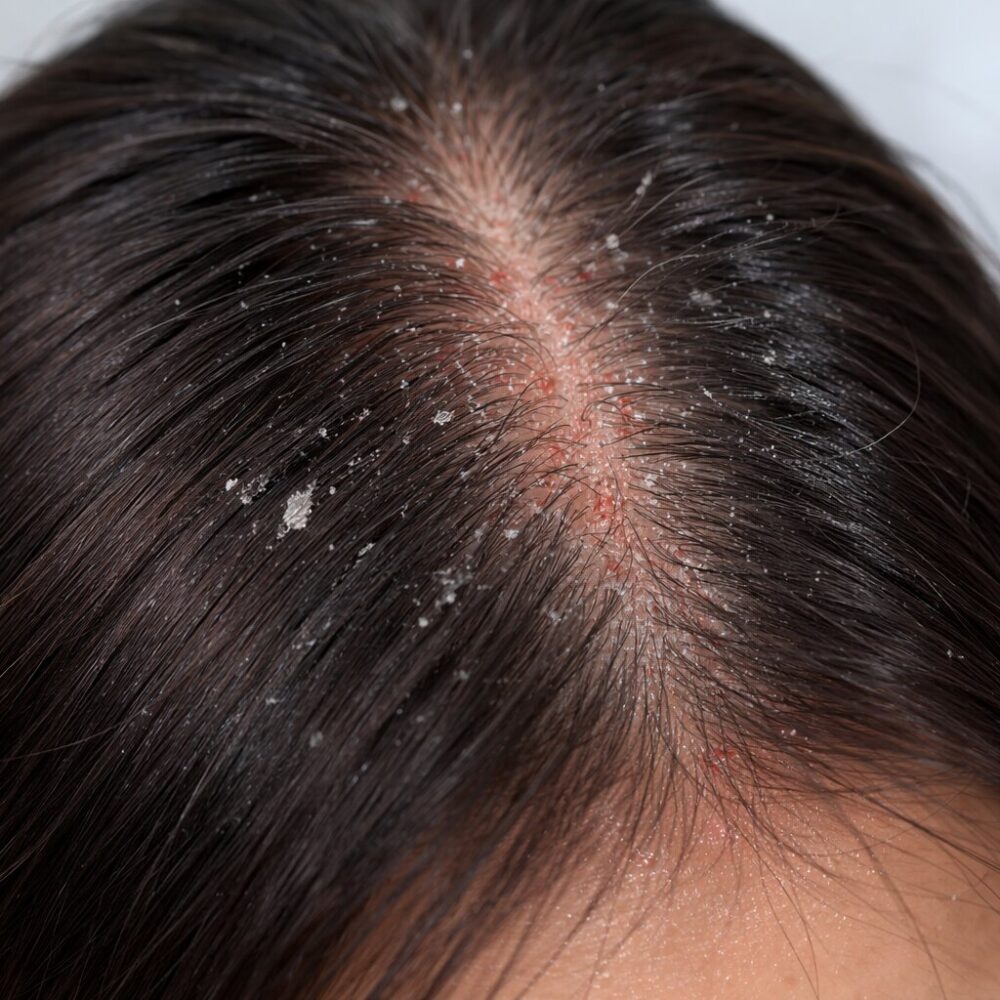 S.H.C Dandruff - Related Scalp Hair Concerns