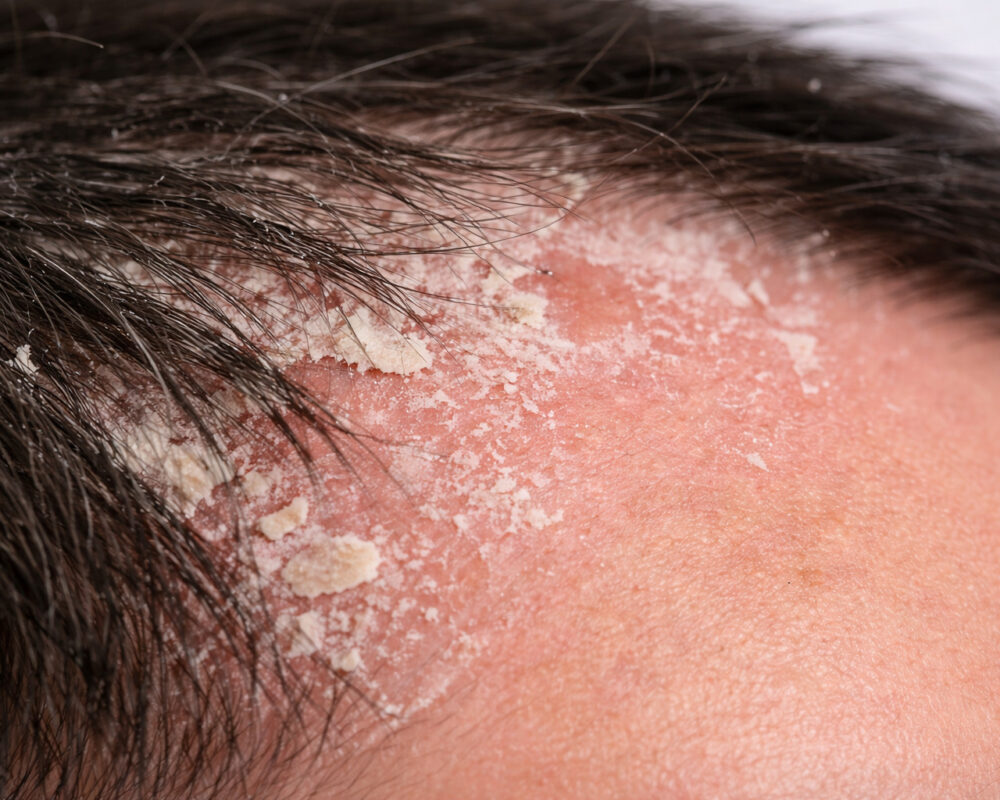 S.H.C Dry Ageing - Related Scalp Hair Concern
