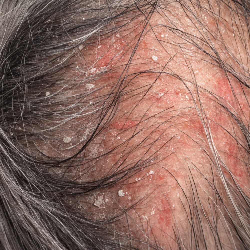 S.H.C Grey Hair - Related Scalp hair Concern