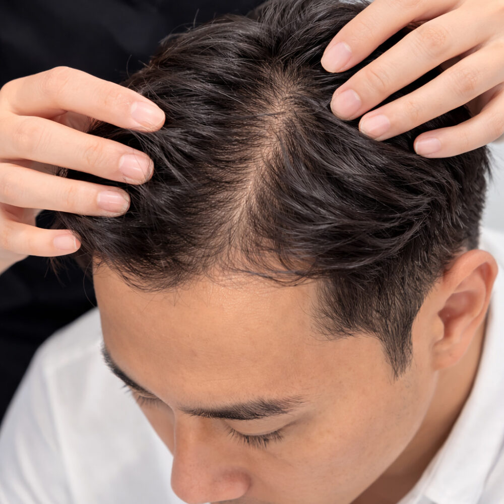 S.H.C Hair Loss - Related Scalp Hair Concern