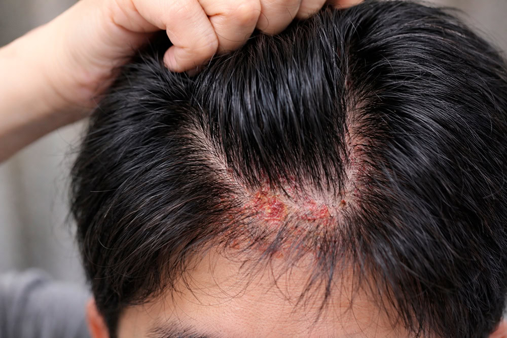 S.H.C Itchy - Related Scalp Hair Concerns