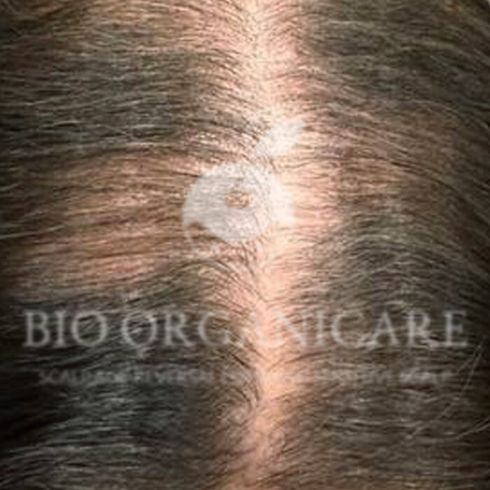 Alopecia Areata - After (Advanced Cases)