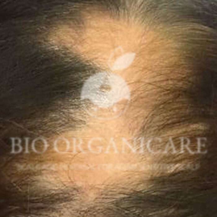 Alopecia Areata - Before (Advanced Cases)