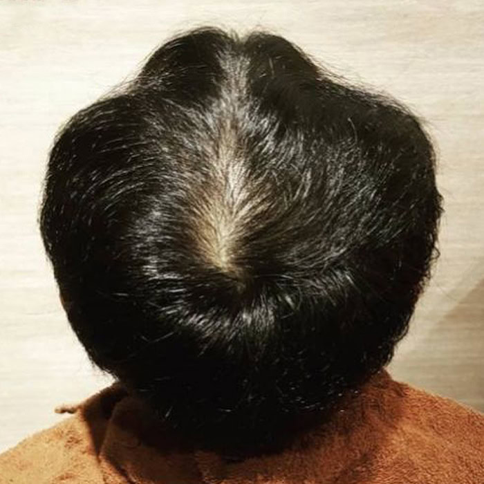 Case 2 Androgenetic Hair Loss - AFTER