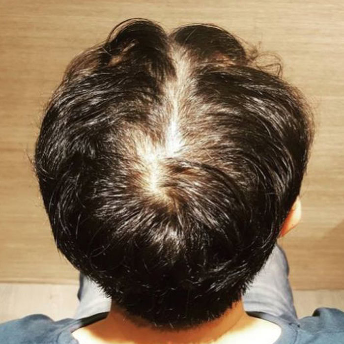 Case 2 Androgenetic Hair Loss - Before