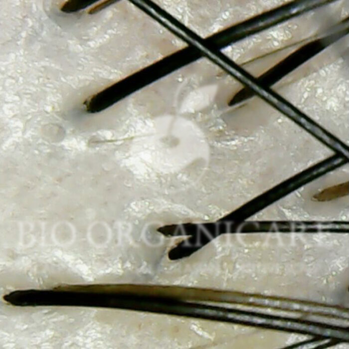 Dandruff - After (Dandruff _ Oily Scalp _ Sensitive)