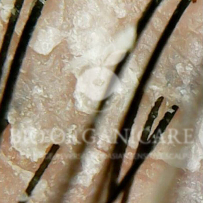 Dry Flaky - Before (Dandruff _ Oily Scalp _ Sensitive)