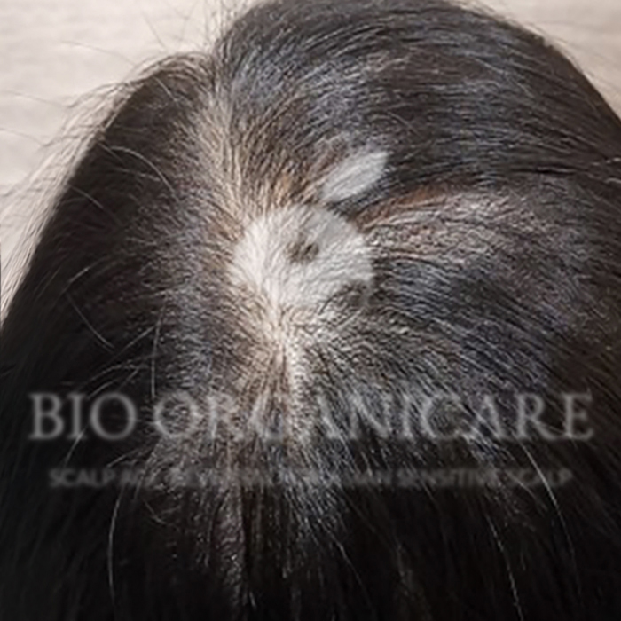 Early Hair Thinning - After (Case 1)