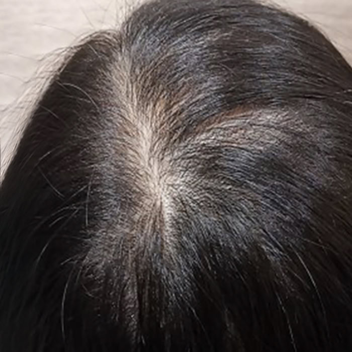 Early Hair Thinning - After