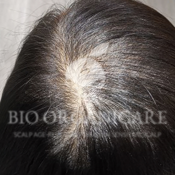 Early Hair Thinning - Before (Case 1)