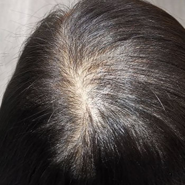 Early Hair Thinning - Before