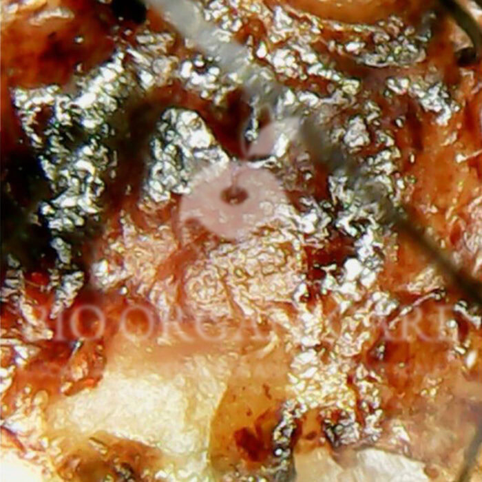 Fungal - Before (Advanced Cases)