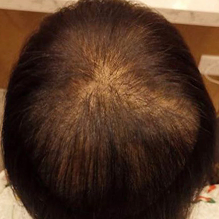 Hair Loss - After