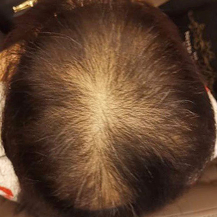 Hair Loss - Before
