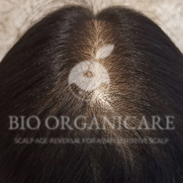 Hormonal - After (Hair Loss)