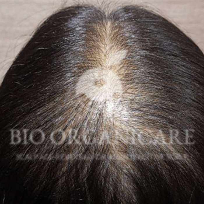 Hormonal - Before (Hair Loss)