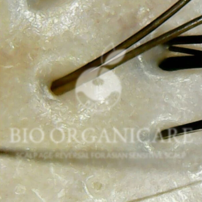 Inflammation - After (Dandruff _ Oily Scalp _ Sensitive)