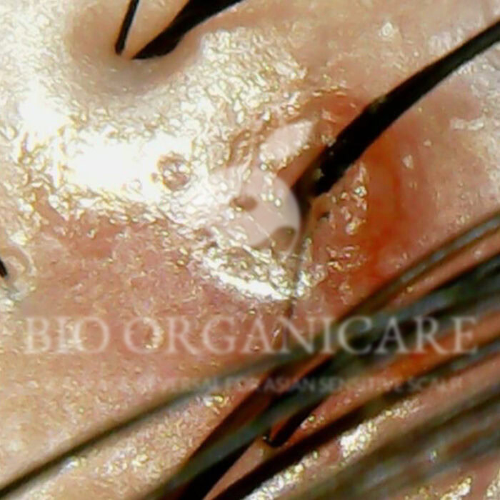 Inflammation - Before (Dandruff _ Oily Scalp _ Sensitive)