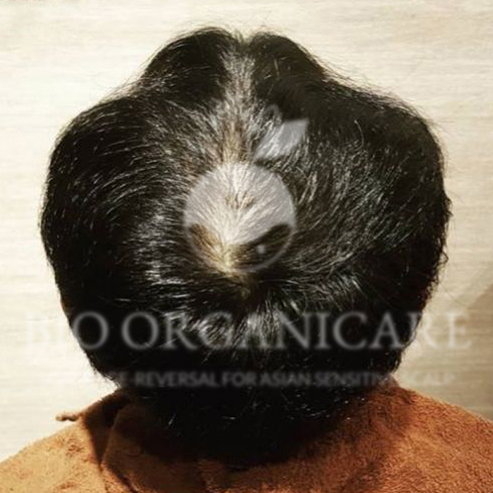 Male Hair Loss - After (Case 2 Androgenetic)