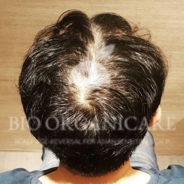 Male Hair Loss - Before (Case 2 Androgenetic)