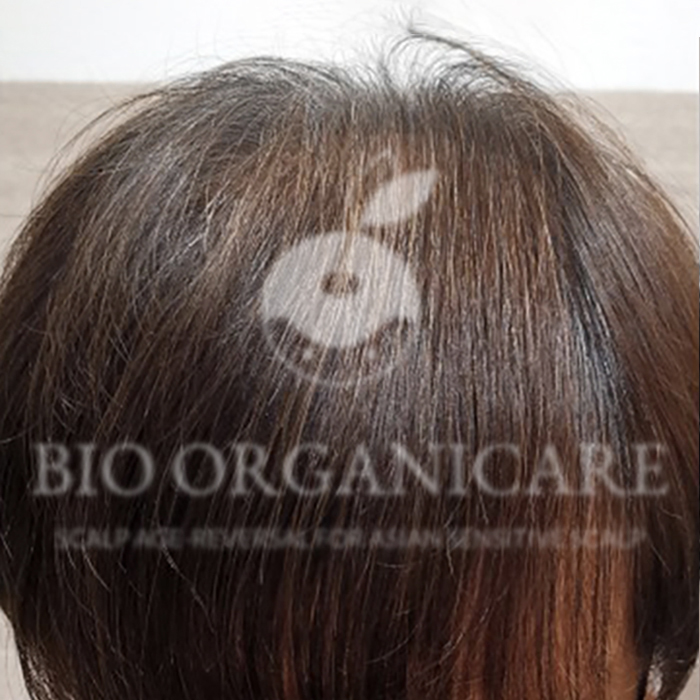 Male Pattern - After (Hair Loss)