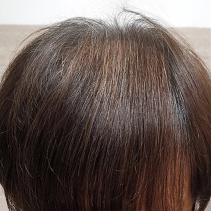 Male Pattern - After