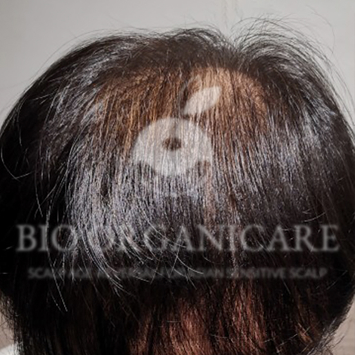 Male Pattern - Before (Hair Loss)