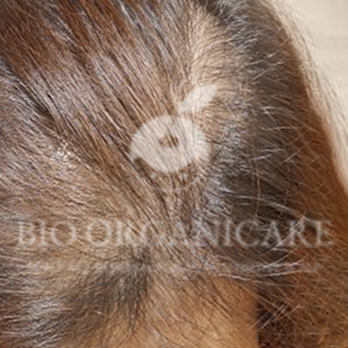 Oily Scalp - After (Dandruff _ Oily Scalp _ Sensitive)