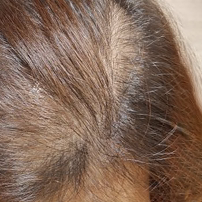 Oily Scalp - After