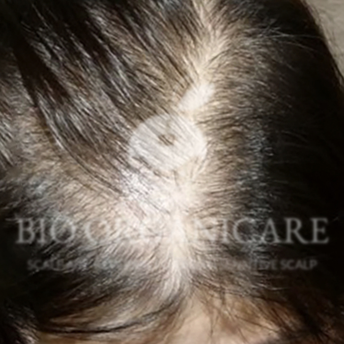Oily Scalp - Before (Dandruff _ Oily Scalp _ Sensitive)