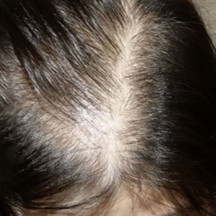 Oily Scalp - Before