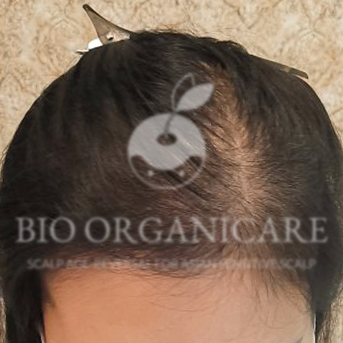 Post Natal - After (Hair Loss)