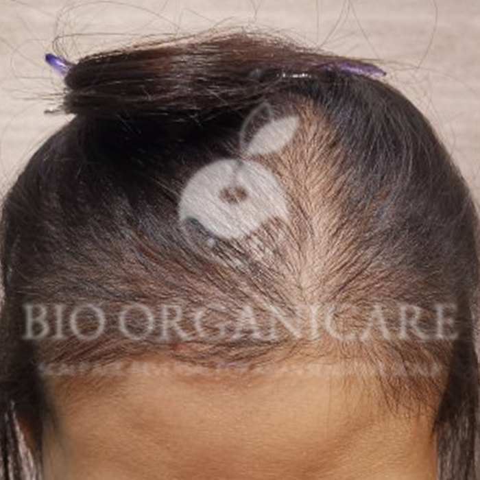 Post Natal - Before (Hair Loss)