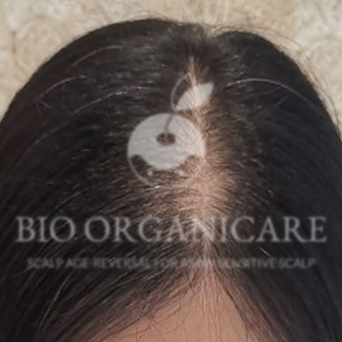 Premature Hair Loss - After (Hair Loss)