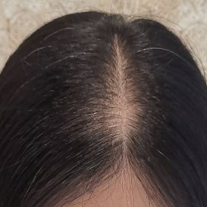 Premature Hair Loss - After